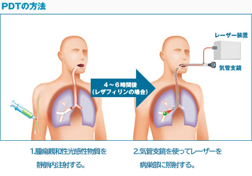 PDTの方法