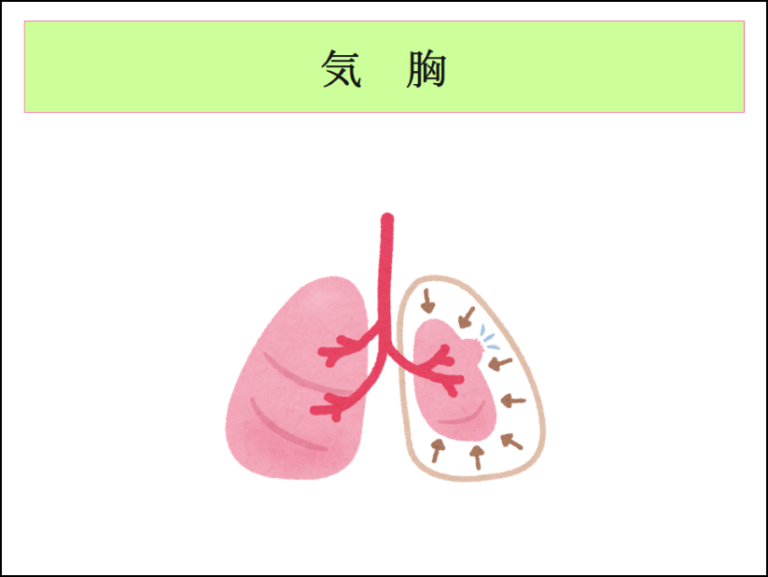 気胸について | 新座志木中央総合病院