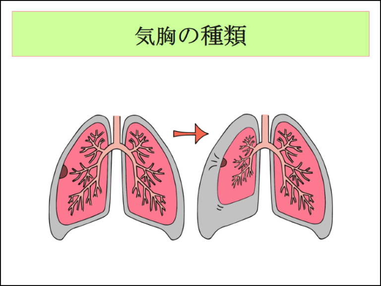 気胸について | 新座志木中央総合病院